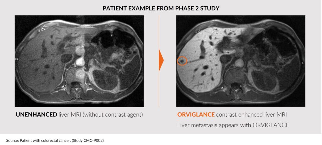 Patient example from phase 2 study